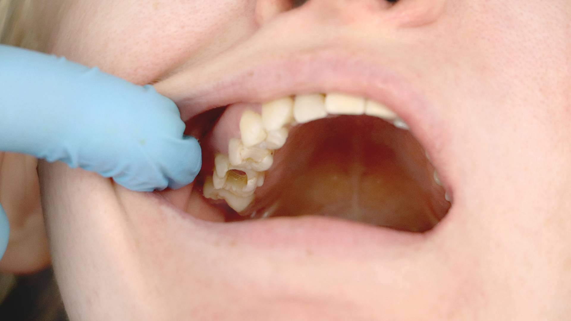 Cảnh Báo Dấu Hiệu Nhiễm Trùng Sau Khi Nhổ Răng Khôn