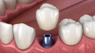 Cấy Ghép Implant: Giải Pháp Phục Hồi Răng Mất Hiệu Quả