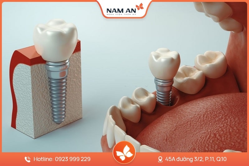 Dịch Vụ Cấy Ghép Trồng Răng Implant Uy Tín Tại Nam An (3)