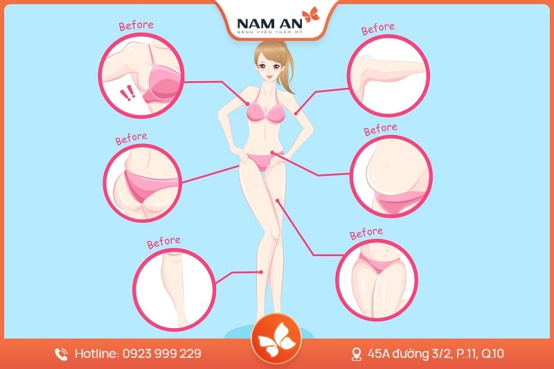Dịch Vụ Hút Mỡ Toàn Thân An Toàn Tại BVTM Nam An (14)