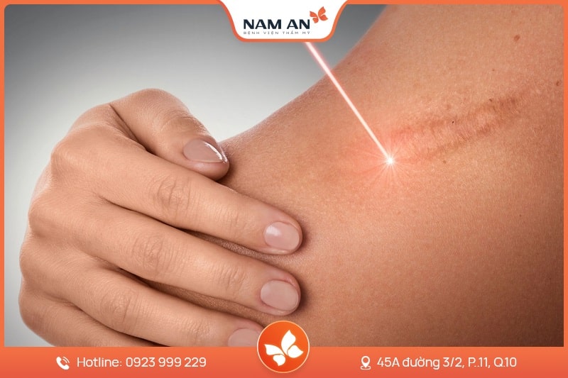 Điều Trị Nám Tận Gốc Bằng Công Nghệ Cao Tại BV Nam An (7)