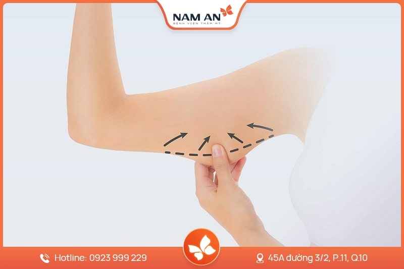 Hút Mỡ Bắp Tay Nhẹ Nhàng, Không Sẹo Tại BVTM Nam An (9)