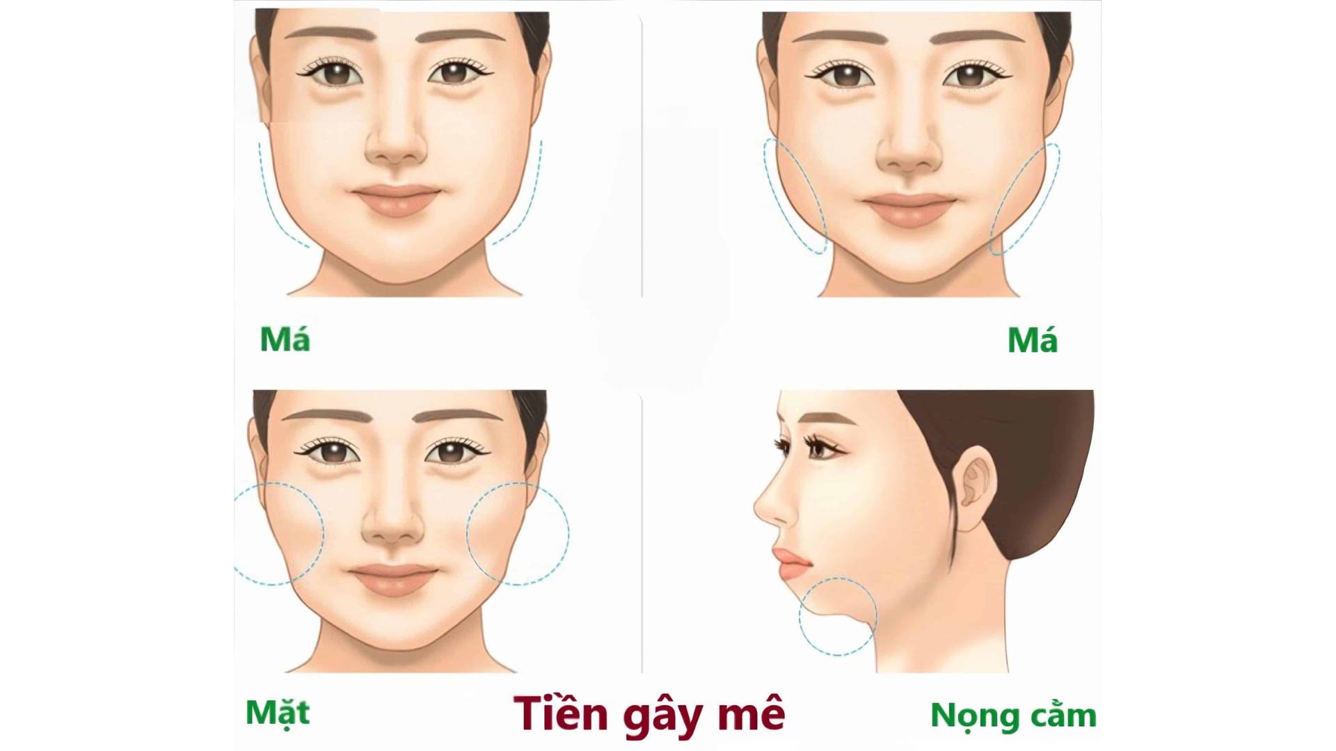 Hút Mỡ Bụng Gây Tê Hay Gây Mê (2)