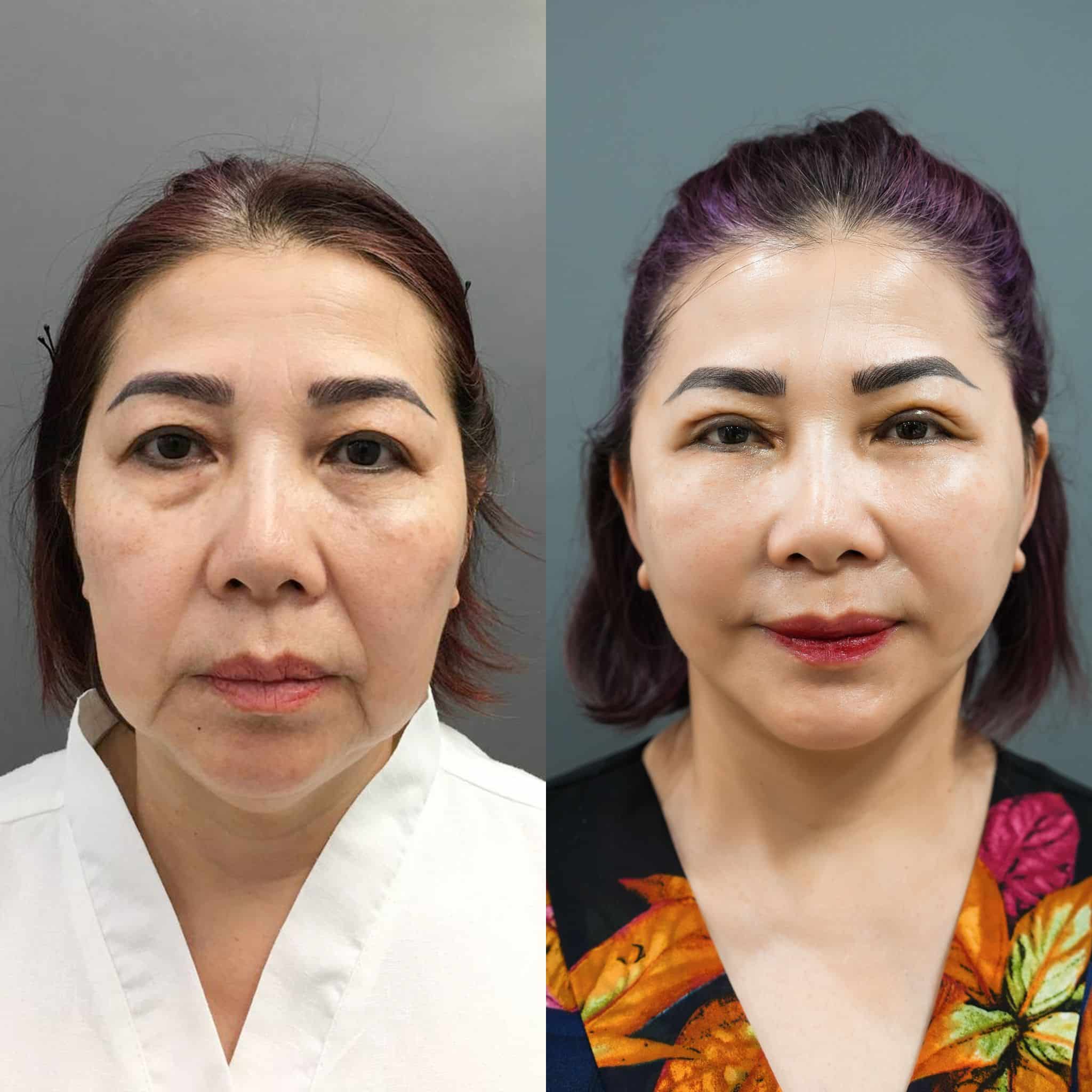 Nên Căng Chỉ Hay Căng Da Mặt Phẫu Thuật So Sánh Chi Tiết (2)
