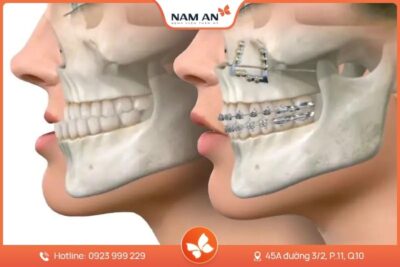 Phẫu Thuật Chỉnh Hàm Móm Do Xương Tại BVTM Nam An