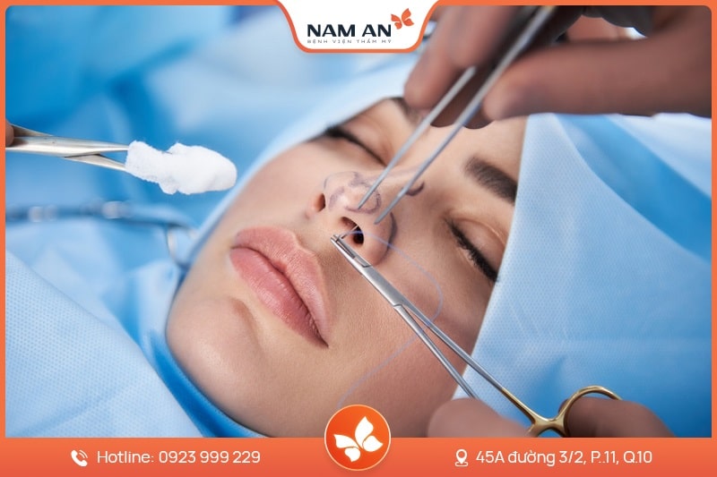 Phẫu Thuật Cuộn Cánh Mũi Thon Gọn Tại BVTM Nam An
