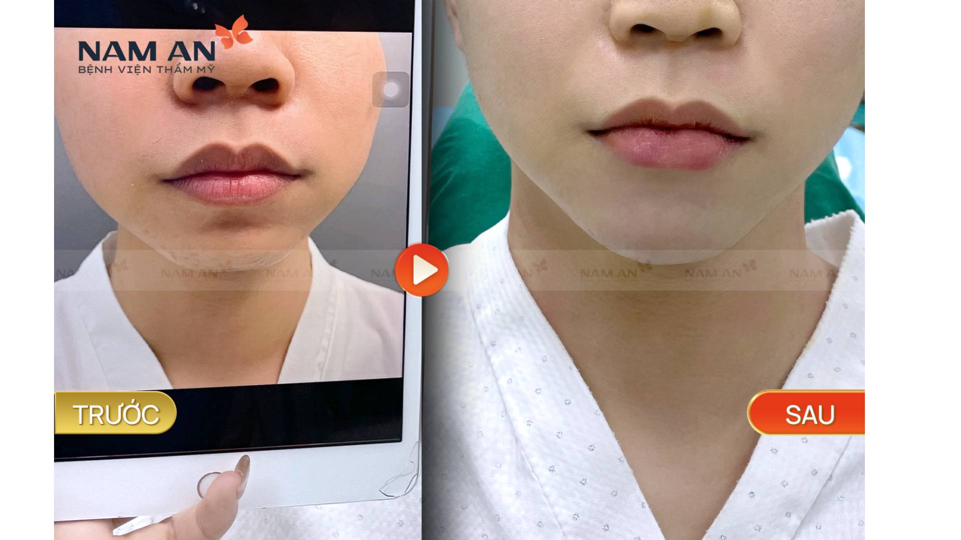 Phẫu Thuật Độn Cằm Duy Trì Được Bao Lâu Giải Đáp (1)