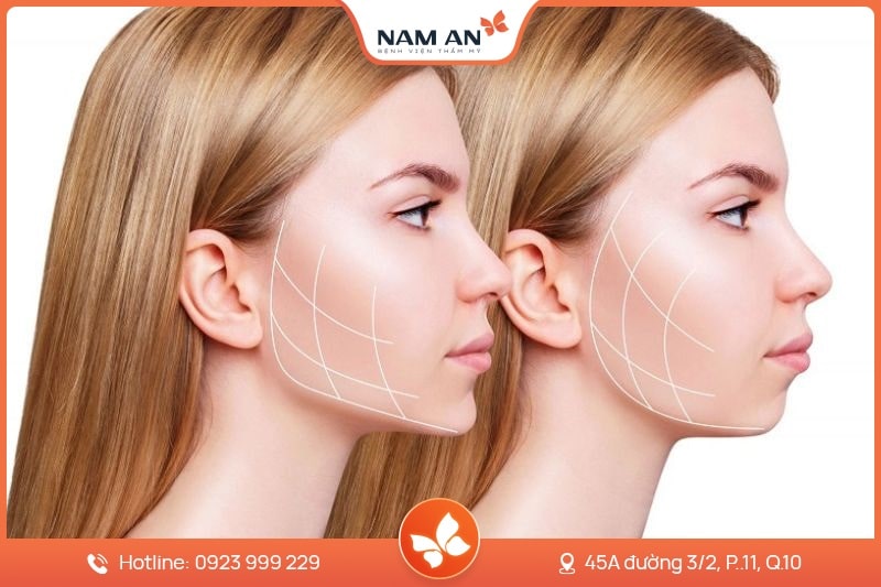 Phẫu Thuật Độn Cằm V-Line Cân Đối Tại BVTM Nam An (5)