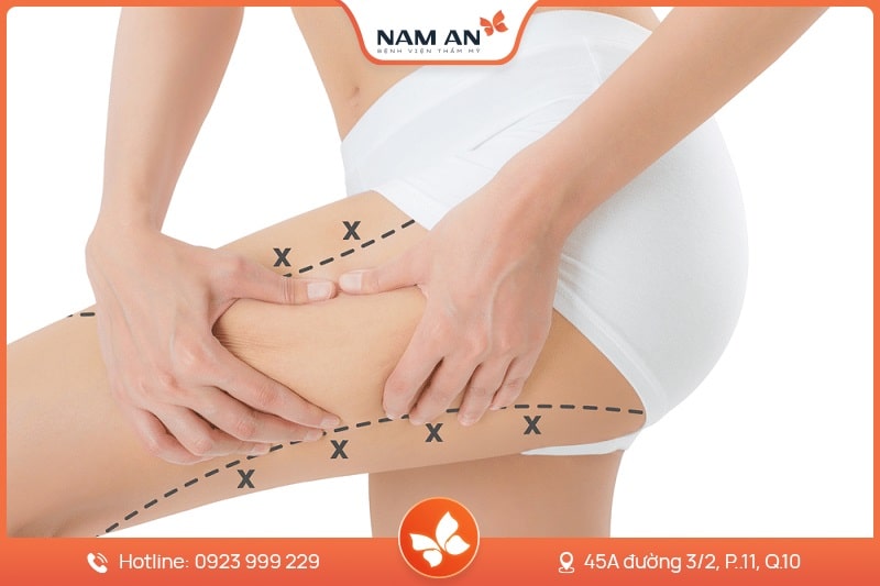 Phẫu Thuật Hút Mỡ Đùi Thon Gọn Tại Thẩm Mỹ Nam An (6)