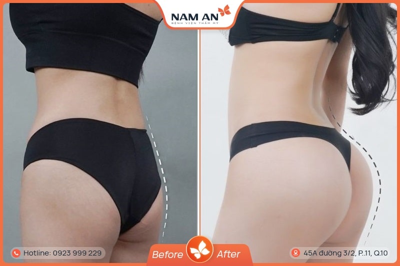 Phẫu Thuật Nâng Mông Nội Soi An Toàn Tại BVTM Nam An (5)
