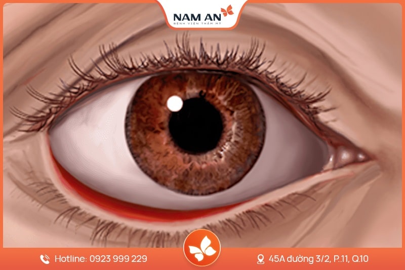 Phẫu Thuật Sửa Lật Mi Mắt An Toàn Tại BVTM Nam An (3)