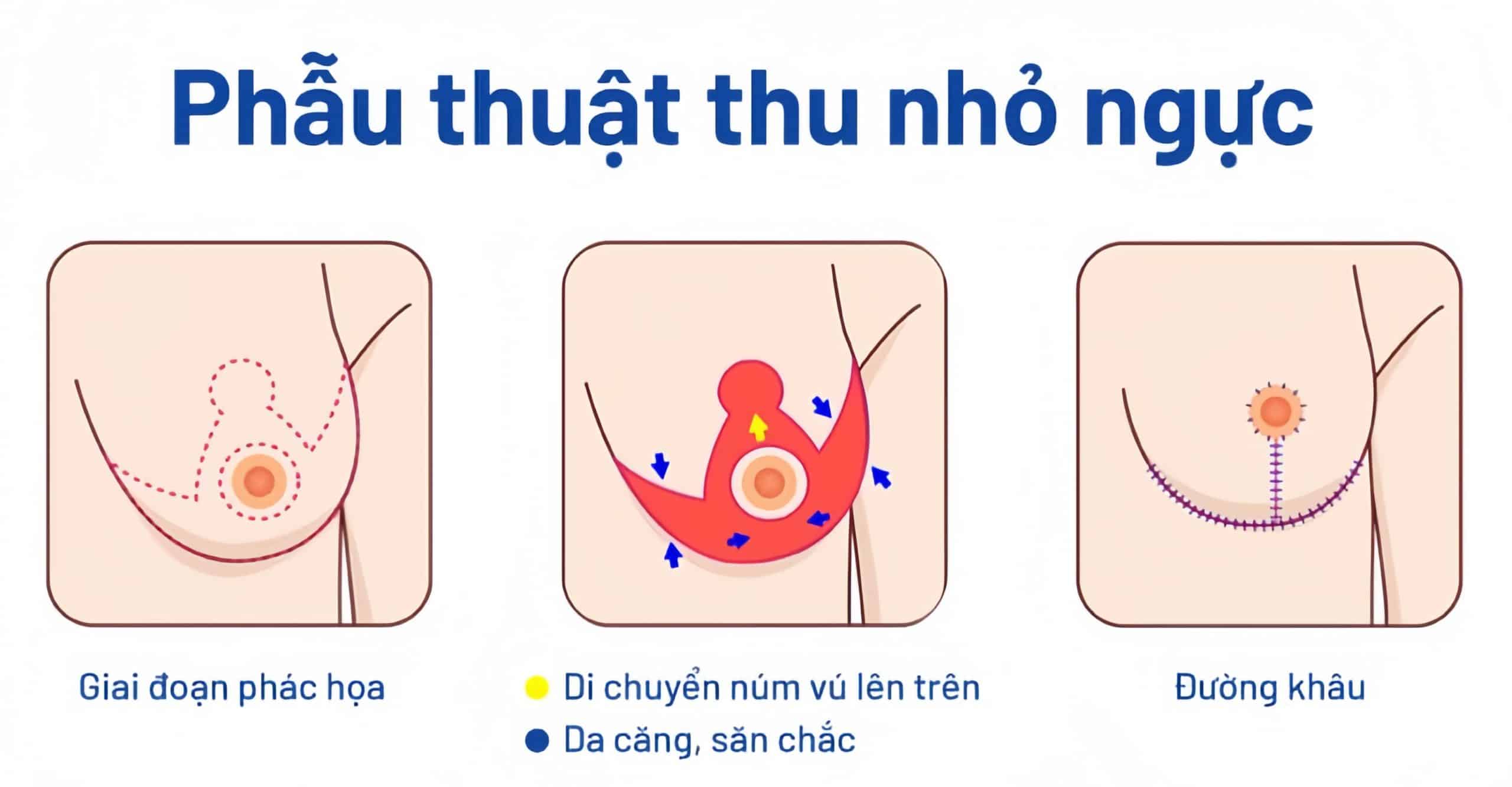 Phẫu Thuật Thu Nhỏ Ngực Phì Đại An Toàn Tại Nam An (3)