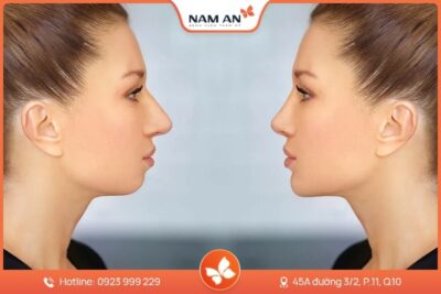 Phẫu Thuật Trượt Cằm Tự Thân Đẹp Tự Nhiên Tại Nam An