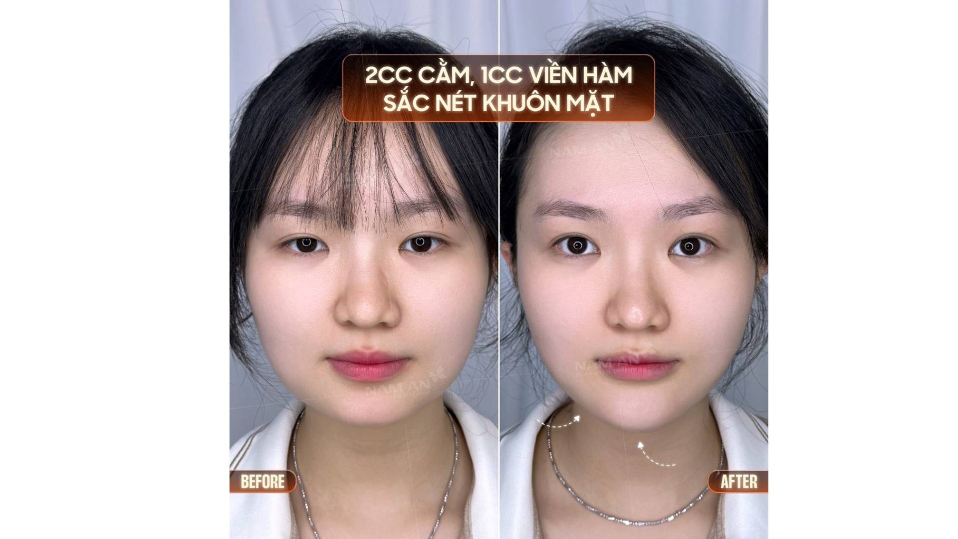 Tiêm Filler Có An Toàn Không Vì Sao Lại Được Ưa Chuộng (3)