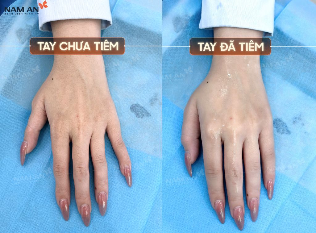 Tiêm Filler Có An Toàn Không Vì Sao Lại Được Ưa Chuộng (4)
