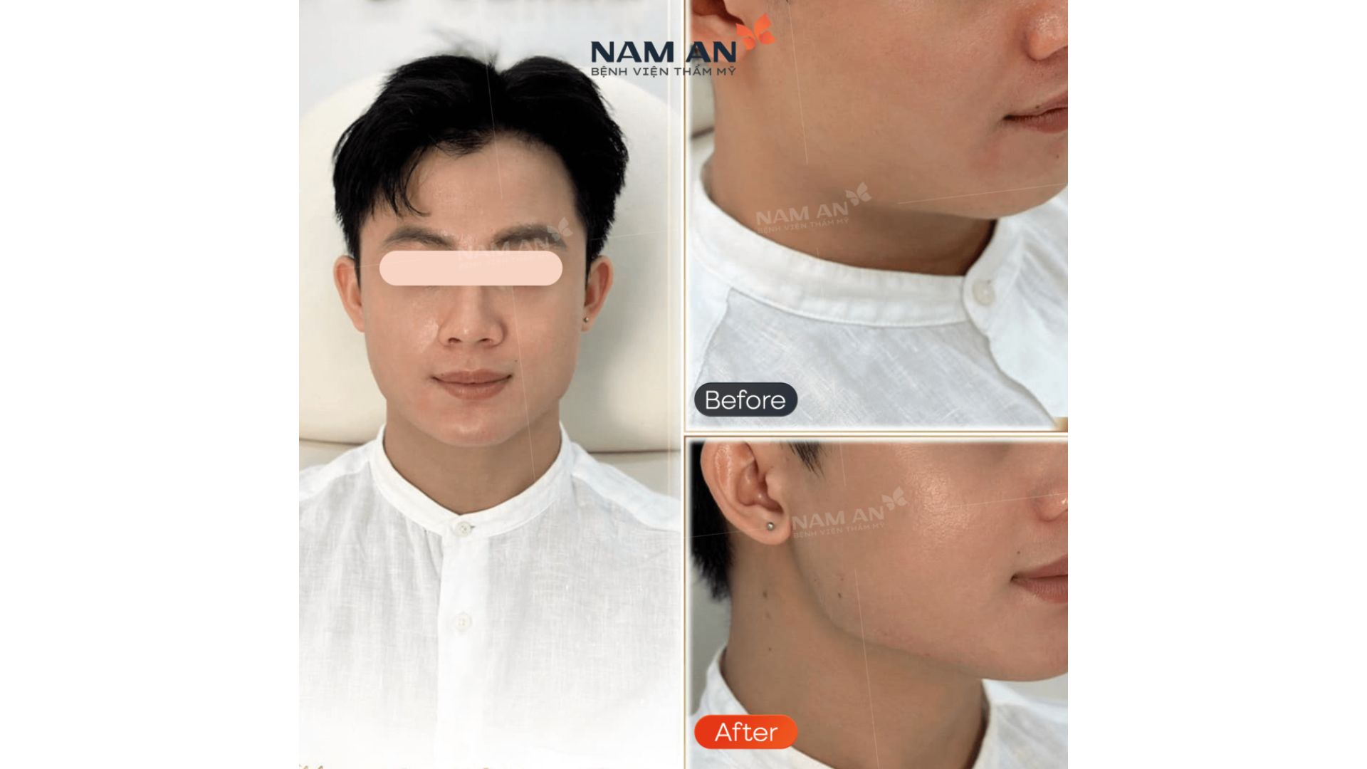 Tiêm Filler Teosyal RHA Tạo Khối Viền Hàm Tại Nam An (1)
