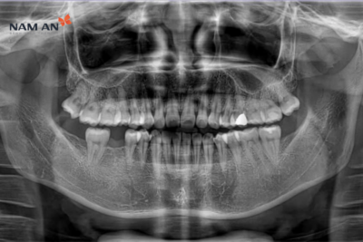 Trồng Răng Implant Mất Bao Lâu? Yếu Tố Ảnh Hưởng