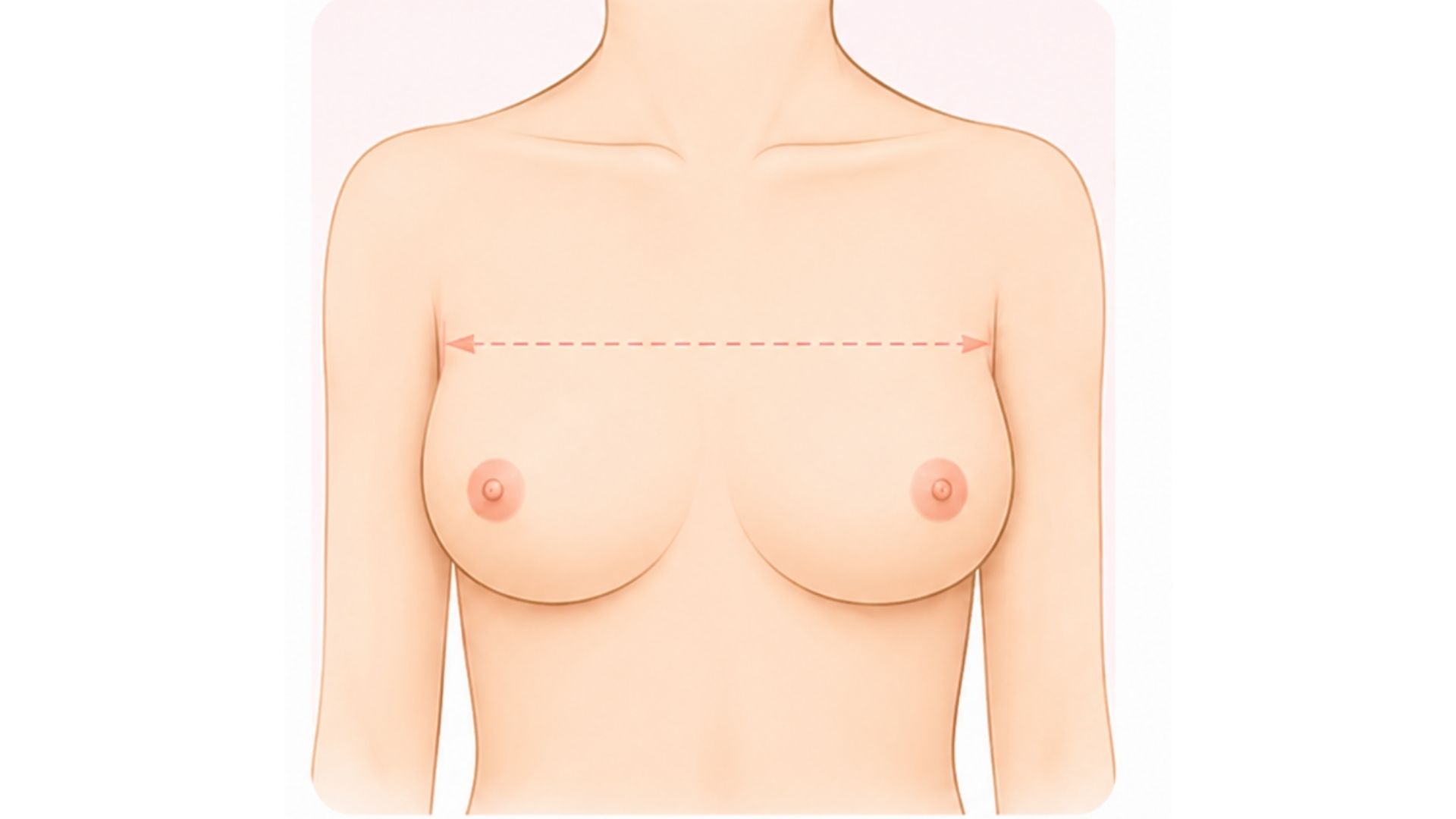 Ngực đông tây là gì_ Dấu hiệu nhận biết theo hình thể thực tế