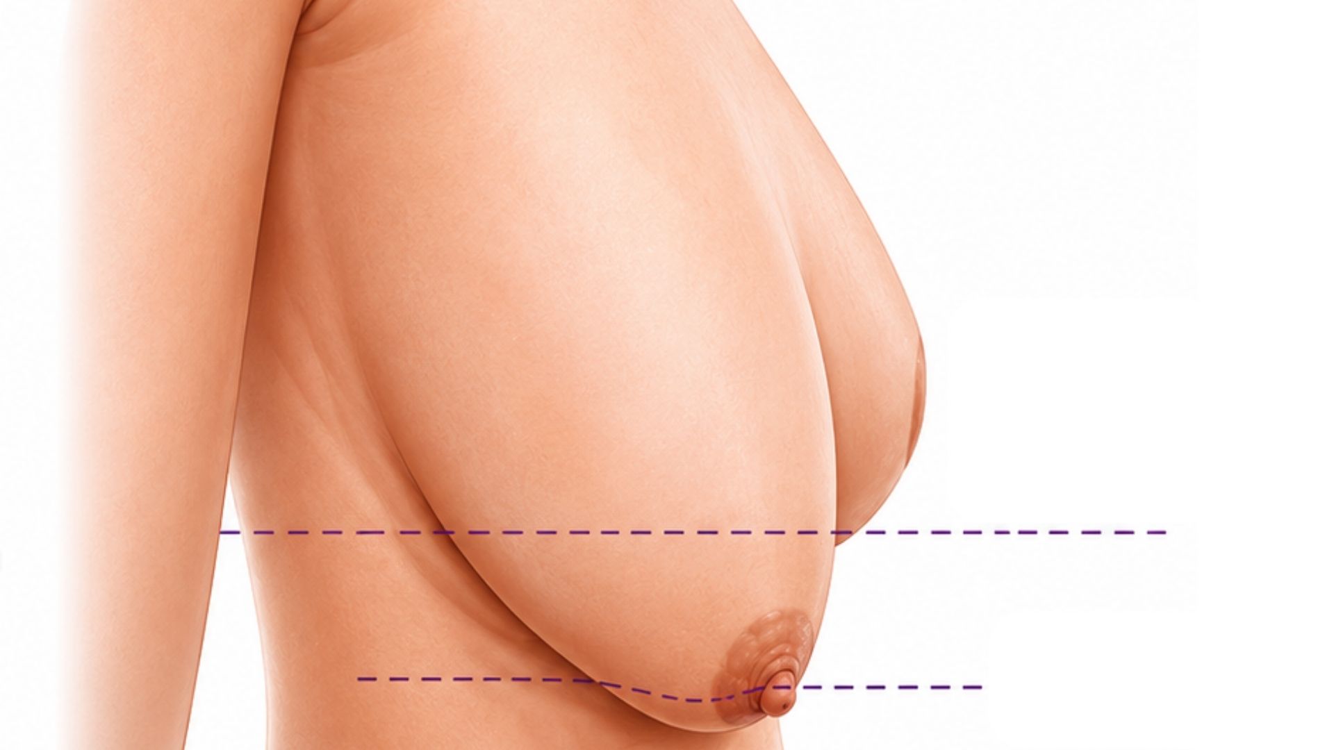Ngực nhão khác với ngực chảy xệ ở điểm nào