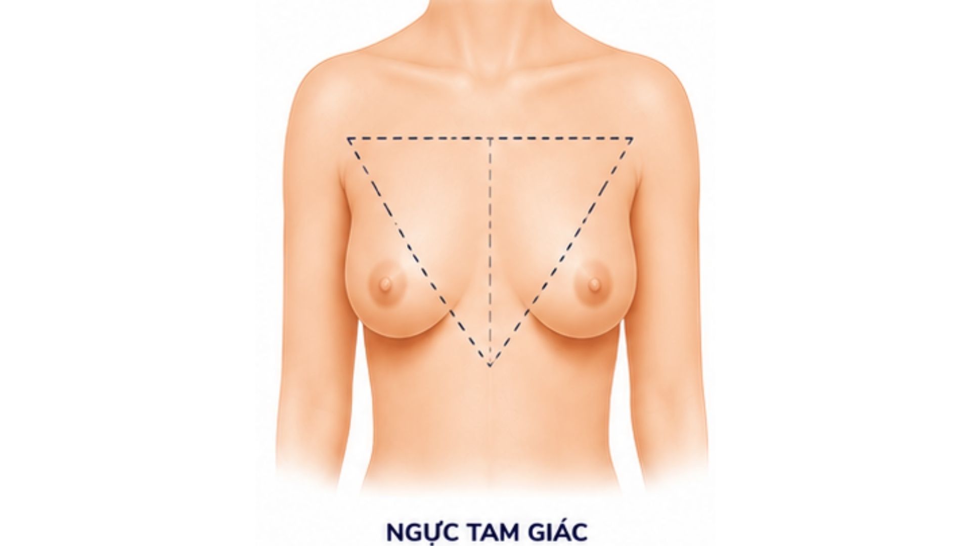 Ngực tam giác là gì và được nhận diện như thế nào
