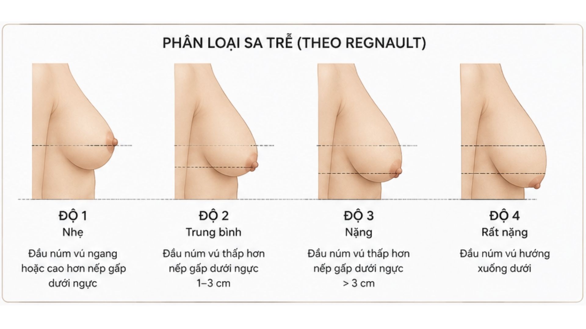 Những thay đổi hình dáng bên ngoài cho thấy ngực đã bị sa trễ