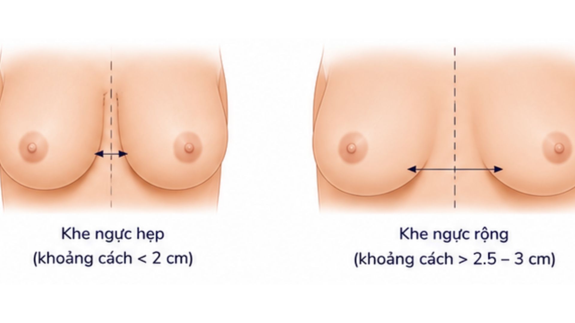 Phân biệt ngực bè ngang bẩm sinh và do túi độn dịch chuyển